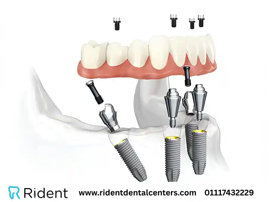 زراعة الأسنان (غرسات الأسنان)